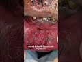 How a Lip Cut Is Treated Professionally | Emergency Wound Care