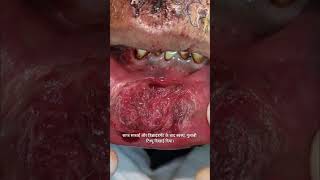 How a Lip Cut Is Treated Professionally | Emergency Wound Care
