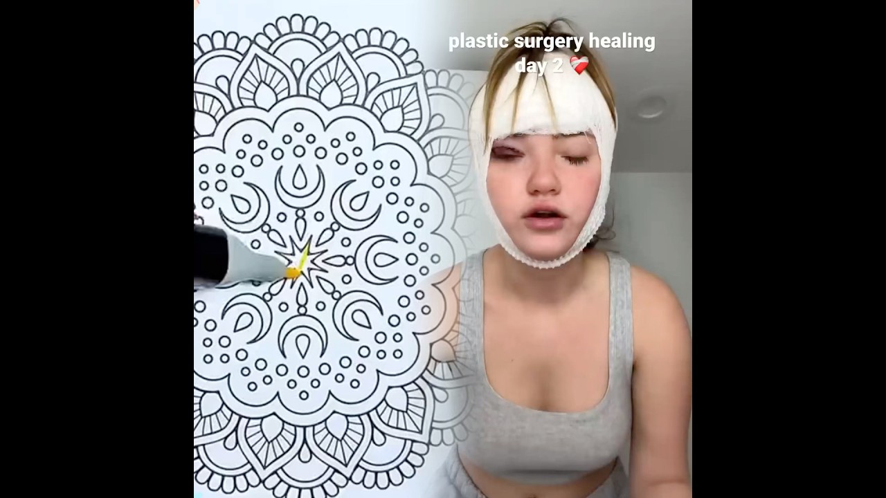 PLASTIC SURGERY RECOVERY (day 2) ❤️🩹 