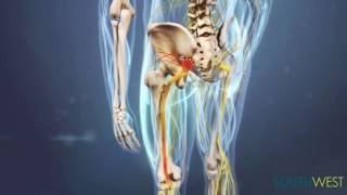 Lumbar Disc Herniations