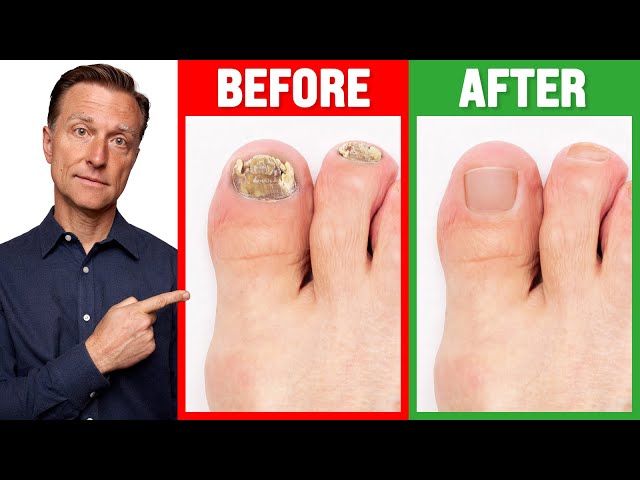 Fungal Toenails | Dubai Podiatry Centre