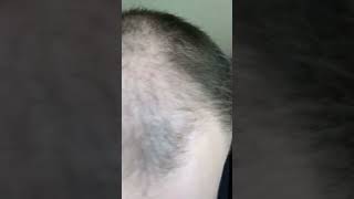 My Balding Head Is A Landing Strip for UFOs 🛸 #Shorts