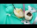 Восстановление зуба пломбой | влог стоматологов | стоматология Самара