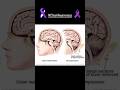 #chiarimalformation #chiariawareness #chiari #surgery #chronicpain #brain #fyp