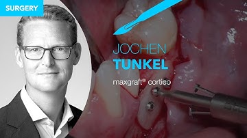 Live surgery by Dr. Jochen Tunkel – maxgraft® cortico