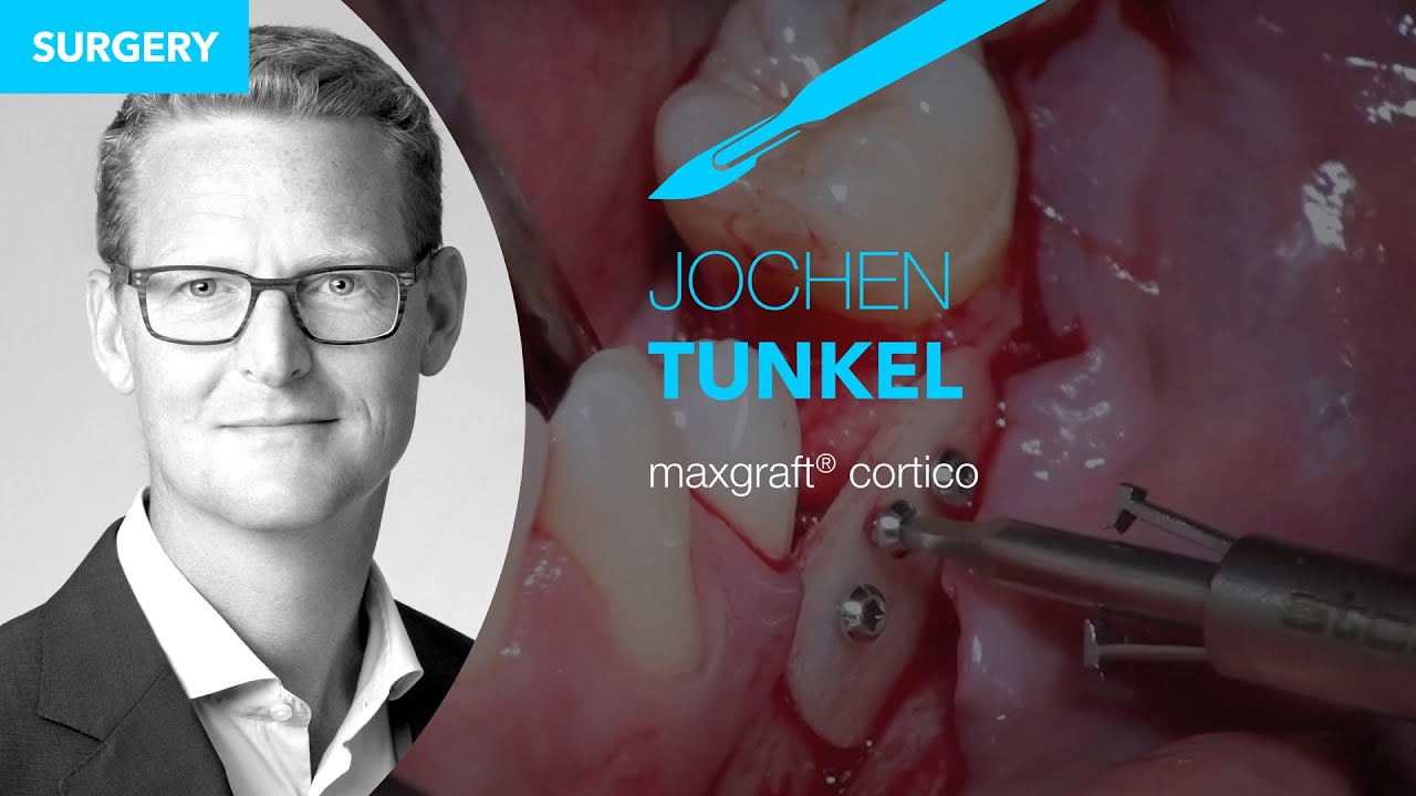 Live Surgery – maxgraft® cortico