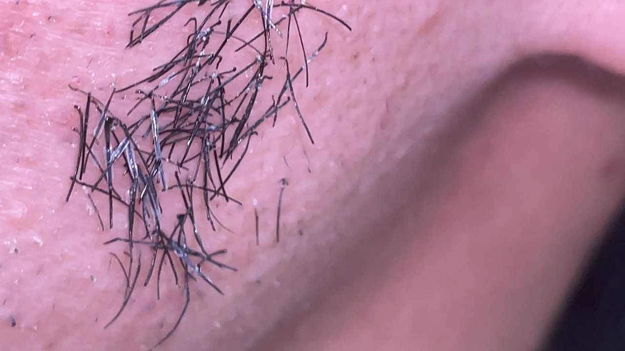Plucking facial hair 350 頬髭抜き YouTube
