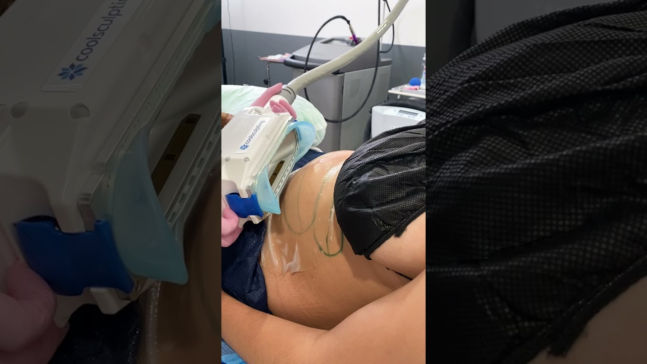 CoolSculpting: The Chillest Way To Tone Up By Summer ❄️