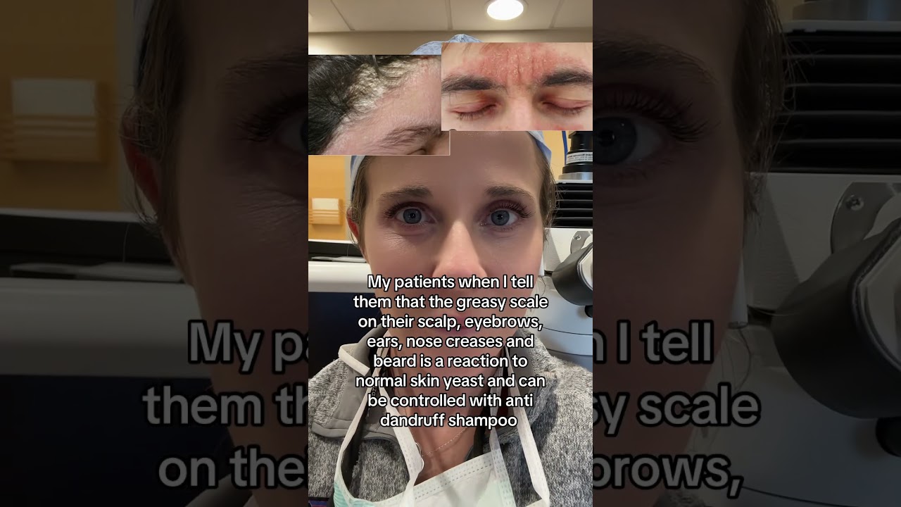 Seborrheic dermatitis is not just dandruff. 