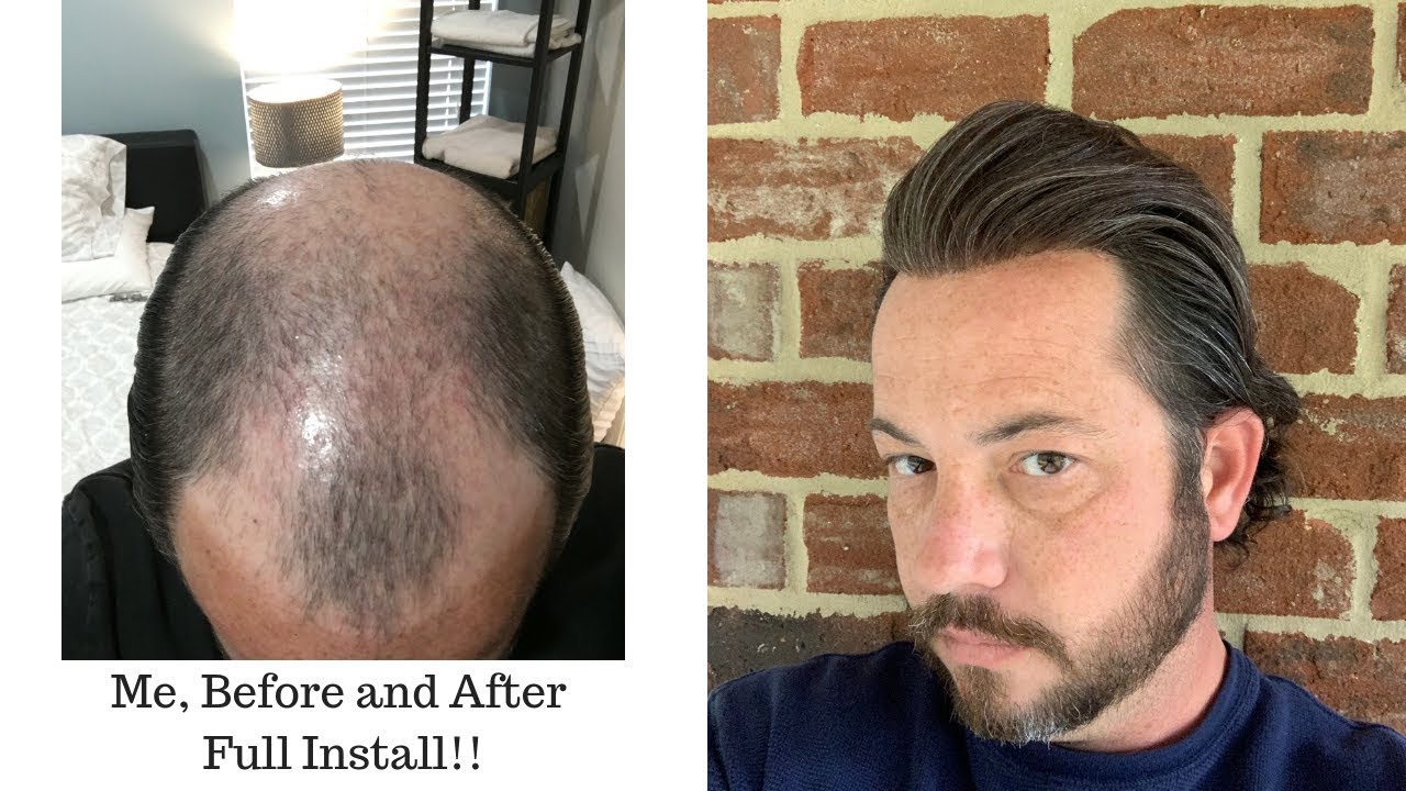 Me, Before and After  Full Removal Of A Thin Skin Poly Hair Replacement or Hair System