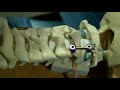 C1c2 posterior fixation techniques sawbone model demonstration