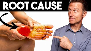 Peripheral NEUROPATHY (Root Cause and Best Remedy) - Dr. Berg