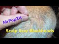 Scalp scar blackhead extractions. Scar tissue on scalp filling with keratin extracted. MrPopZit.