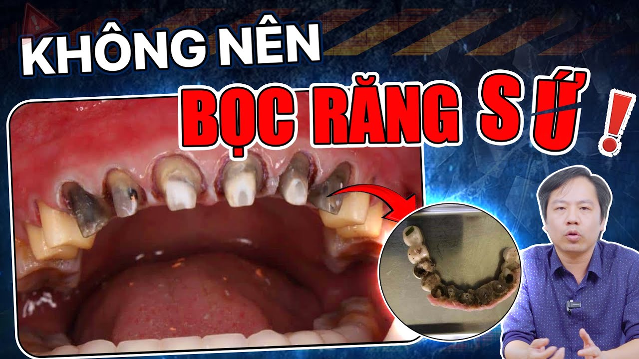 Outline Video Có Nên Bọc Răng Sứ Không? Đừng Bọc Răng Sứ Nếu Gặp 3 Trường Hợp Điển Hình Này!