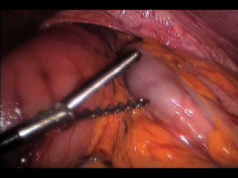 8216GS Laparoscopic Repair of Postesophagectom... ...