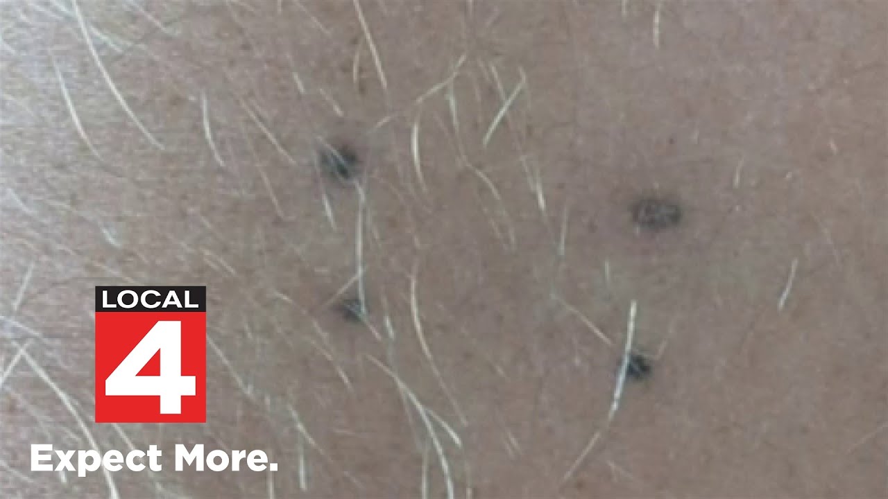 Medical experts test radiation tattoos that can fade away