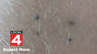 Medical experts test radiation tattoos that can fade away