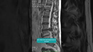Грыжа позвоночника. Когда лечить консервативно нет смысла? Разбор МРТ пациента с грыжей L5S1, L3-L4