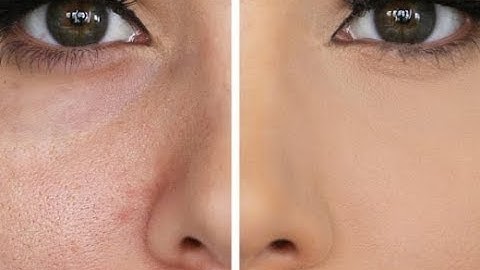 Si t’i mbyllni poret e fytyrës pa shkuar fare te dermatologu
