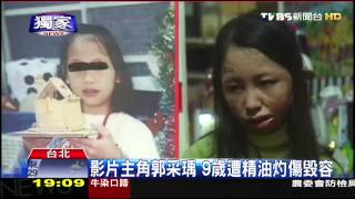 〈獨家〉TVBS獨家專訪主角9歲遭精油灼傷毀容 