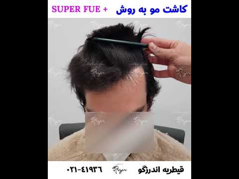   کلینیک های رایان مو سلامت کاشت مو به روش پلاس