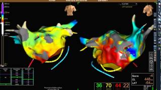 2016 04 Ensite Precision   Left AFL ablation