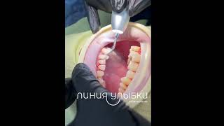 Профгигиена #ортодонт # #доктор #лечениезубов #стоматологиякиев#зубки #ровныезубы#белыезубы