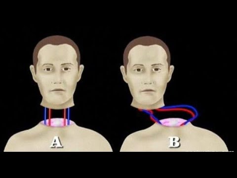 Сенсация: Пересадка головы Сенсация: Пересадка головы