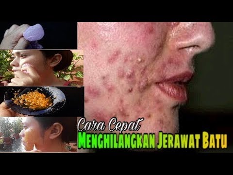 Cara Menghilangkan Jerawat Batu | how to remove Cystic acne