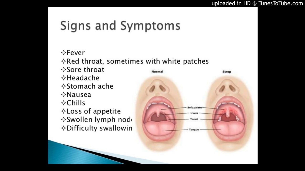 diabetes throat strep group infection Adult b