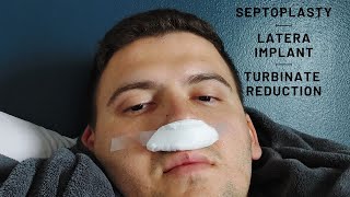 Septoplasty | Latera Implants | Turbinate Reduction. What to know. Tips. Recovery hacks.