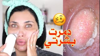 انصدمت 😬 بشرتي تحت الميكروسكوب | جهاز شفط الرؤوس السوداء