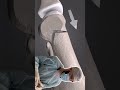 Ответ на самые частые вопросы, по поводу операции на Hallux Valgus