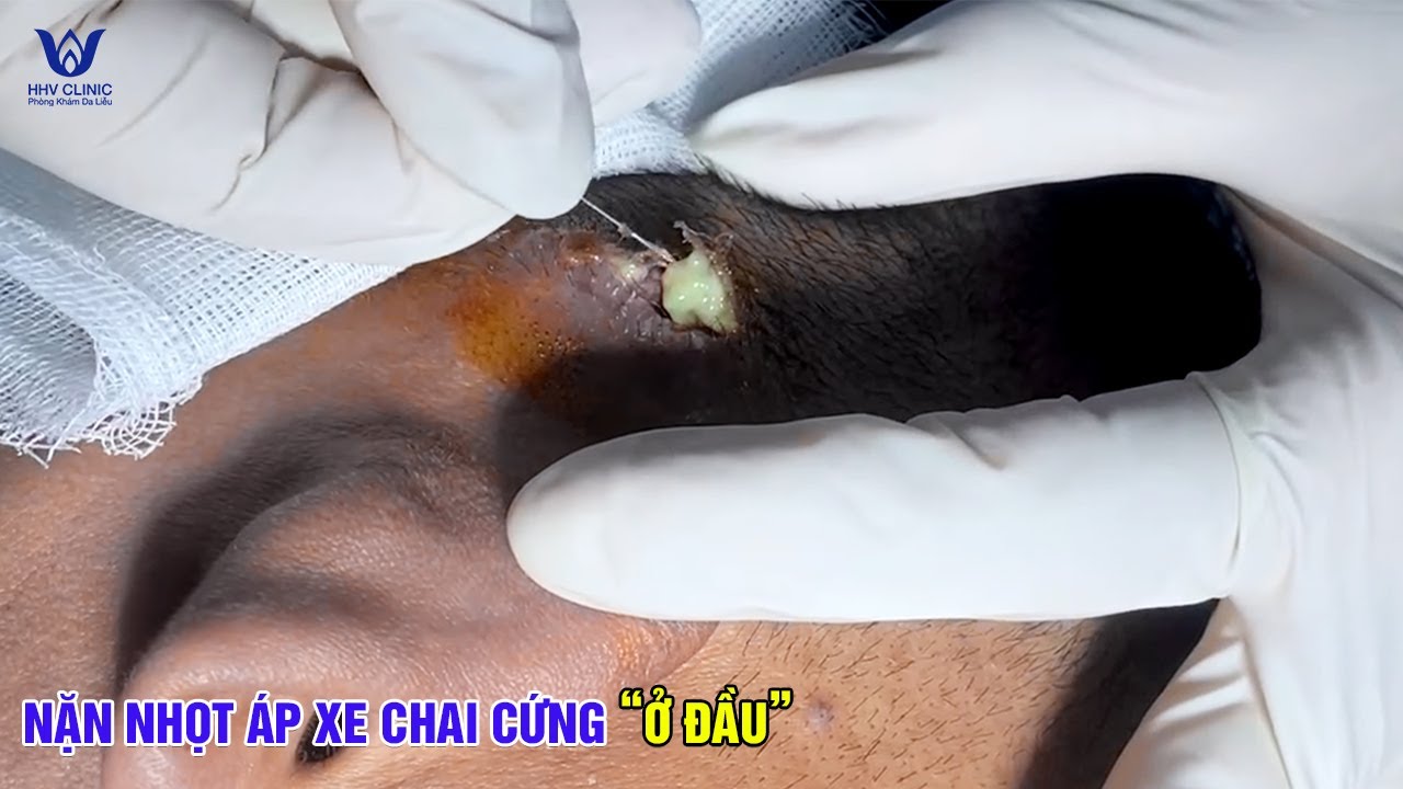 Mụn mủ trắng trên da đầu khi lấy ra khiến người xem nổi da gà.