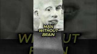 How he lived without Brain 🤯 #shortsfeed #shorts