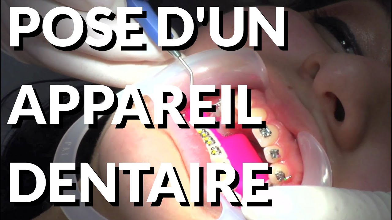 Pose d'un Appareil Dentaire - Appareil-dentaire.info - YouTube
