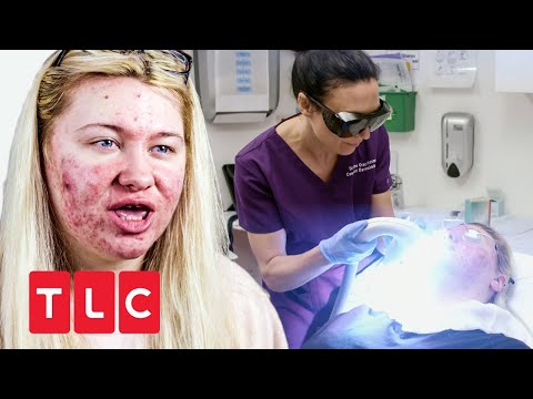 Laser gegen Akne | Dr. Emma: Hautärztin aus Leidenschaft | TLC Deutschland
