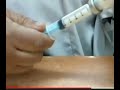 ابره عضل حقنه بنسلين نسبه الميكرو ب لاعطاء حقنه البنسلين