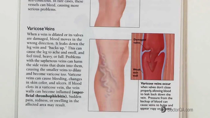 Are varicose veins hereditary? - Dr. William Bower...