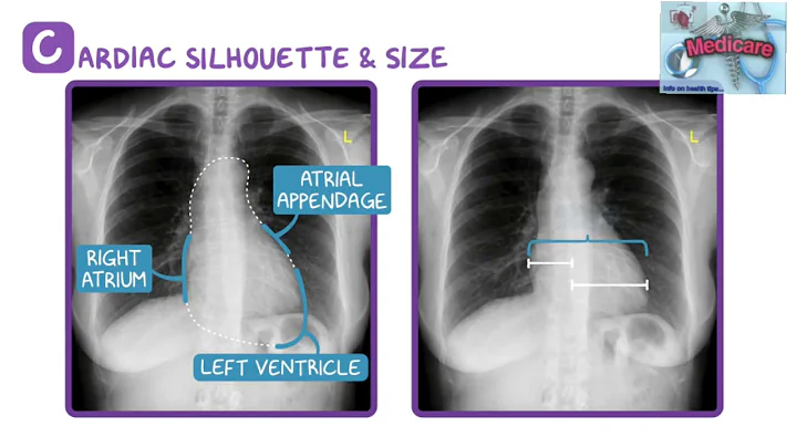 Reading a chest x-ray/Learn to read a chest x-ray in 5 min