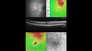 EPIRETINAL MEMBRANE EN-FACE OCT ANALYSIS For more images like this visit www.retinography.org #ofta