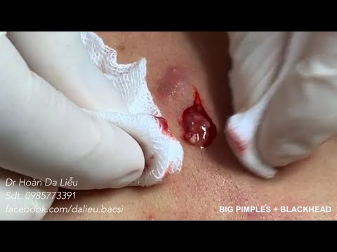 CHÍCH NHỌT VÙNG LƯNG|Dermatologist treating squeeze big pimples, whitehead blackhead, pustule, acnes