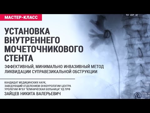 Установка внутреннего мочеточникового стента