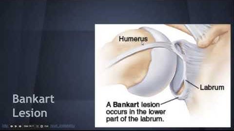 Shoulder Dislocation: Associated injuries -   EM in 5