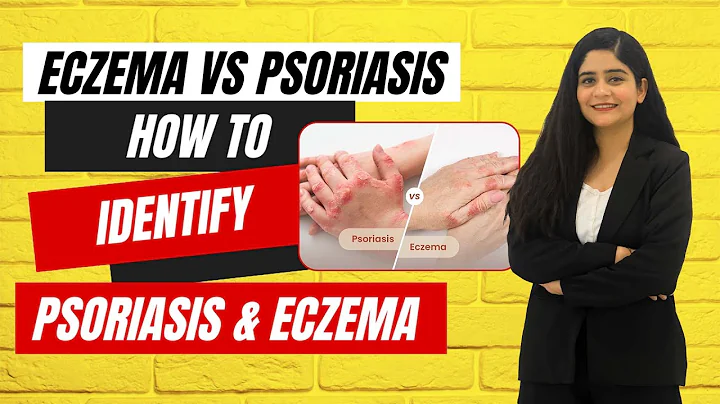 Eczema Vs Psoriasis - How To identify Psoriasis & Eczema | Eczema And Psoriasis Treatment