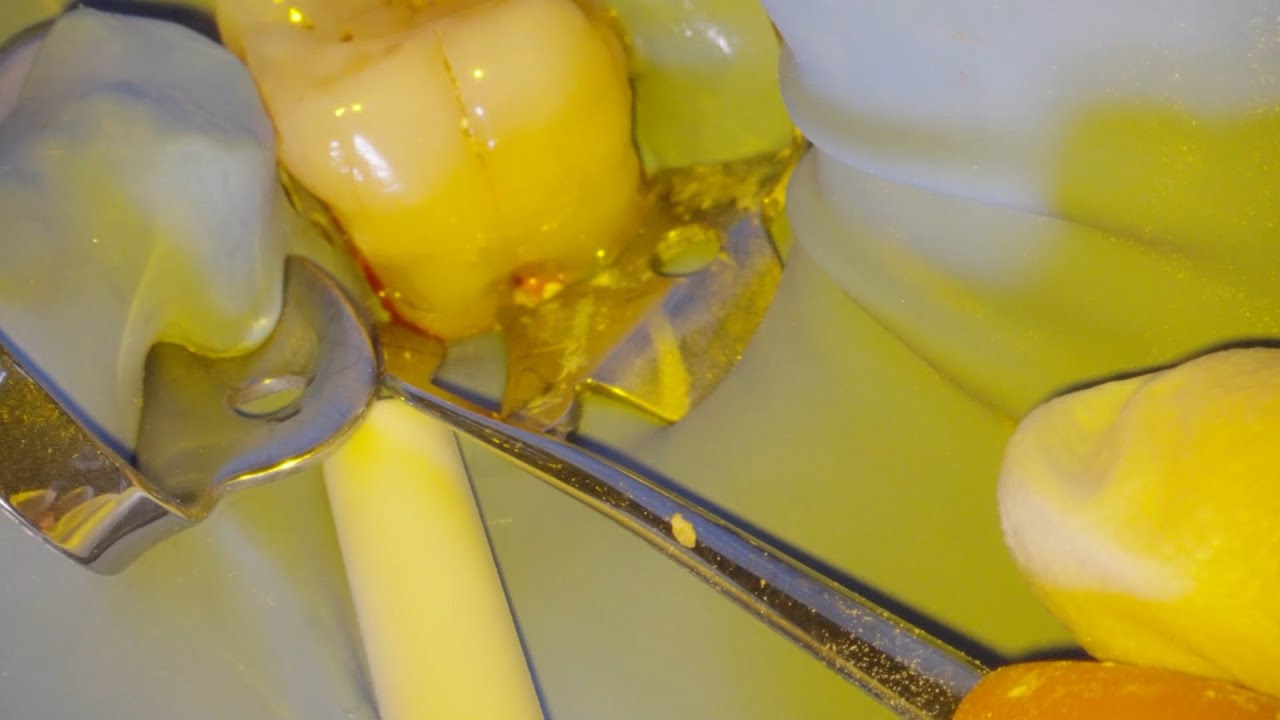 Flapless Crown Lengthening Procedure with SonicLine, followed with