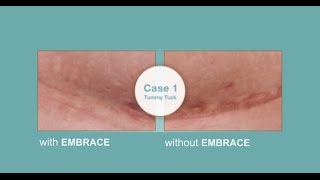 Embrace™ Silicone Tape  vs Traditional Scar Treatments
