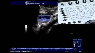 NextGen LOGIQ e: Eject USB Drive