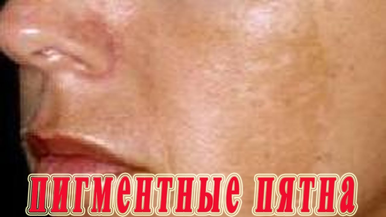 ★Пигментные пятна на лице. Как избавиться. Профилактика пигментации.