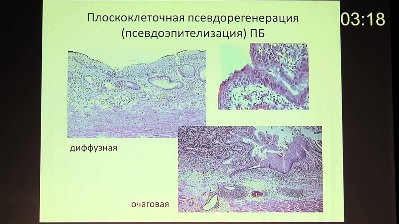 03 Морфологическая диагностика ГЭРБ Воробьев С Л - YouTube